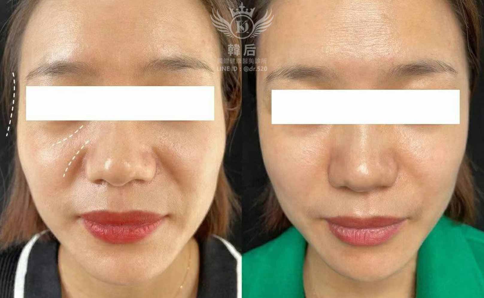 韓后醫美 AestheFill艾麗斯 膠原蛋白 夫妻宮凹陷 法令紋 淚溝凹陷 印地安紋 素人真實案例