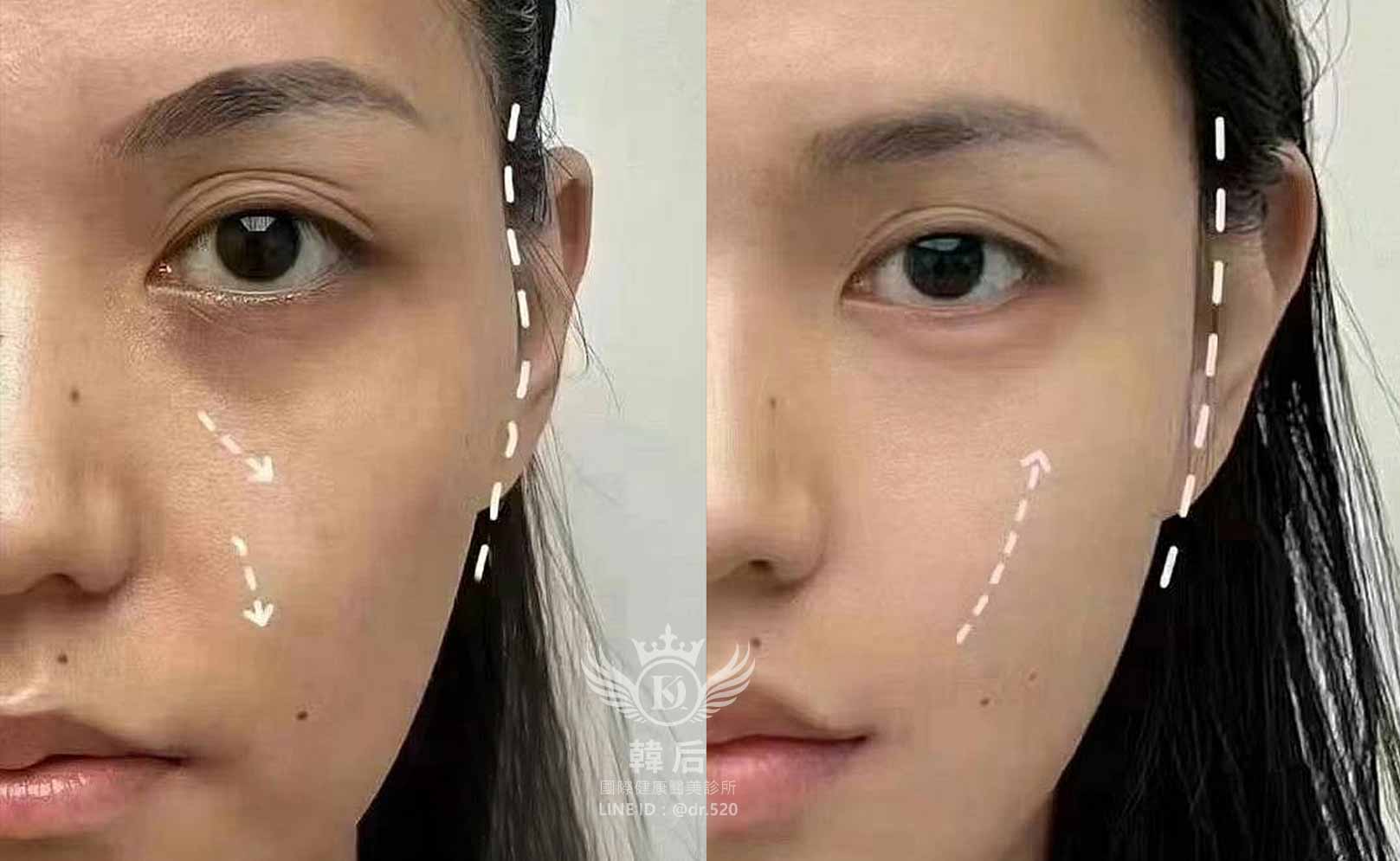 韓后醫美 AestheFill艾麗斯 膠原蛋白 夫妻宮凹陷 法令紋 淚溝凹陷 蘋果肌 臉頰凹陷 素人真實案例