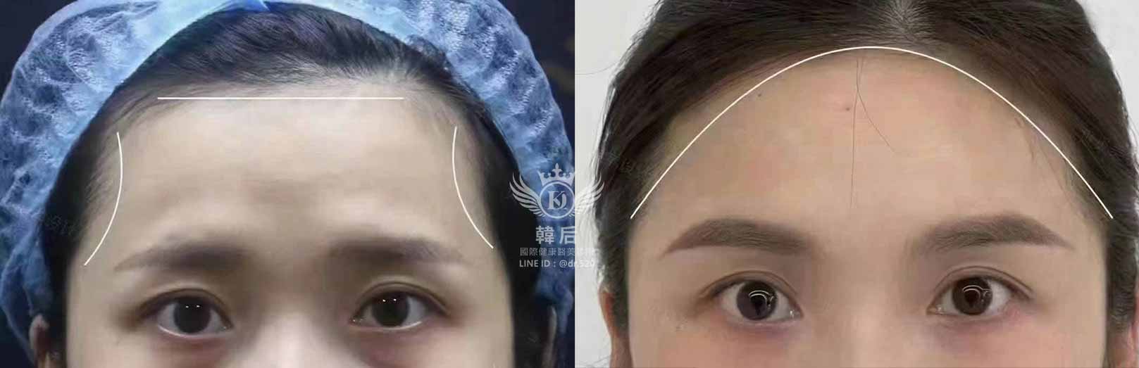 韓后醫美 AestheFill艾麗斯 膠原蛋白 額頭凹陷 素人真實案例