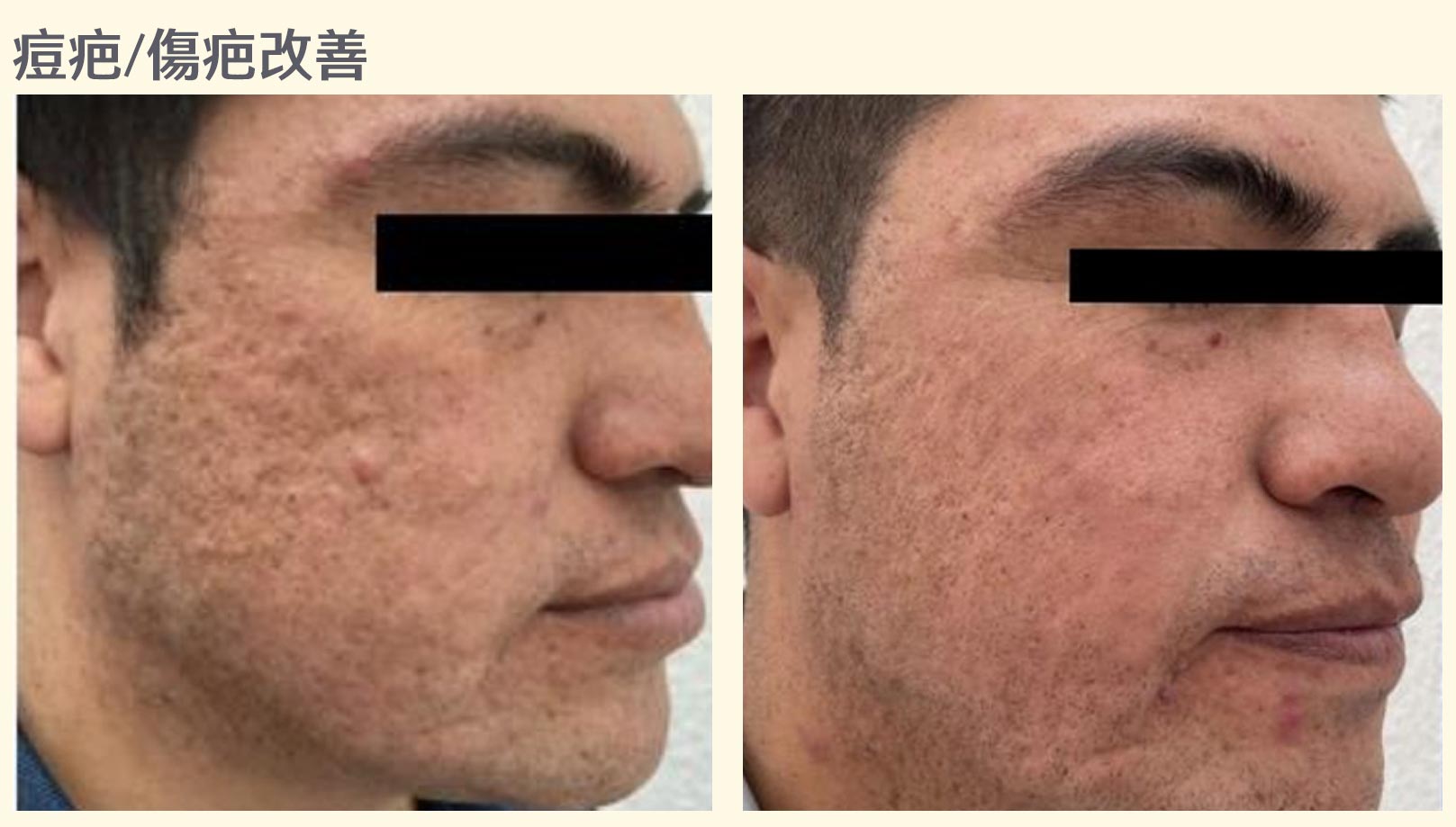 韓后醫美 喬雅露 Juvelook 膠原蛋白 痘痘 疤痕 傷疤 素人真實案例