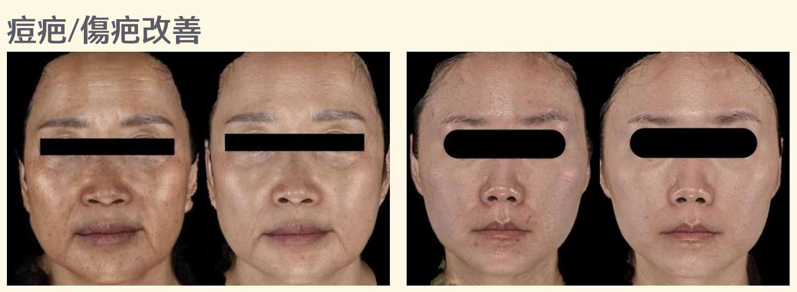 韓后醫美 喬雅露 Juvelook 膠原蛋白 痘痘 疤痕 傷疤 素人真實案例