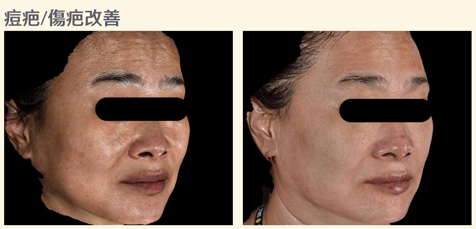 韓后醫美 喬雅露 Juvelook 膠原蛋白 痘痘 疤痕 傷疤 素人真實案例
