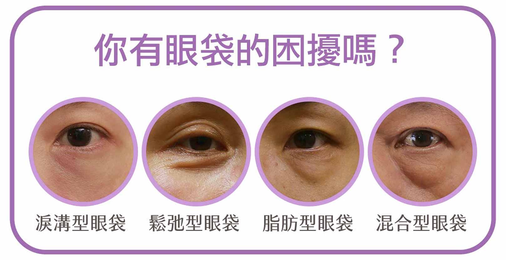 韓后醫美,膠原蛋白熊貓針,双美膚力原膠原蛋白,你有眼袋困擾嗎?分為:淚溝型眼袋、鬆弛型眼袋、脂肪型眼袋、混合型眼袋。