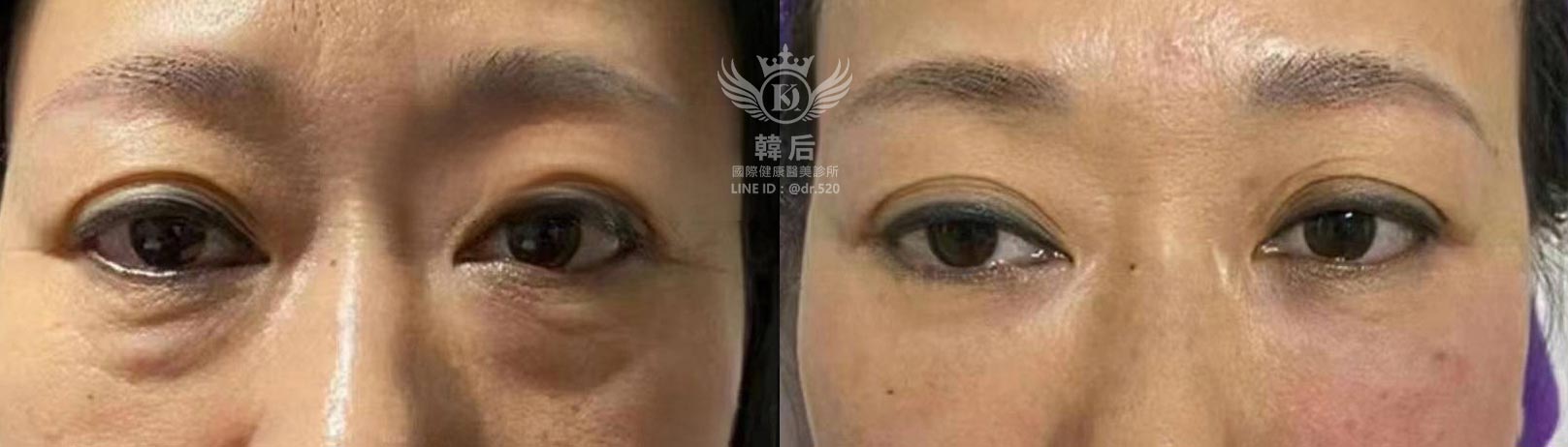 韓后醫美 膠原蛋白熊貓針 双美膚力原膠原蛋白 免手術除眼袋 真實見證