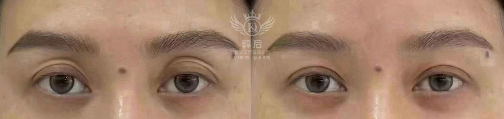 韓后醫美 眼窩凹陷 膠原蛋白熊貓針 双美膚力原膠原蛋白 免手術除眼窩凹陷 真實見證