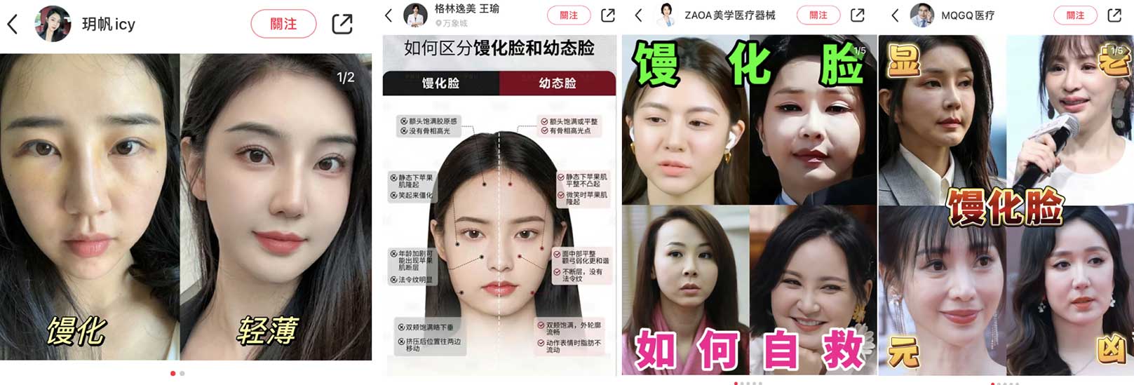 韓后醫美,饅化(Overfilled syndrome，過度填充症候群)是指過度或不當注射填充物引起的面部異常狀況，臉部高光處被大面積填平，常見特徵有：額頭過凸、顴骨高聳、蘋果肌飽滿、嘴唇像香腸嘴、巫婆下巴等，臉部充氣感過重、過於腫脹、輪廓不自然等狀況。