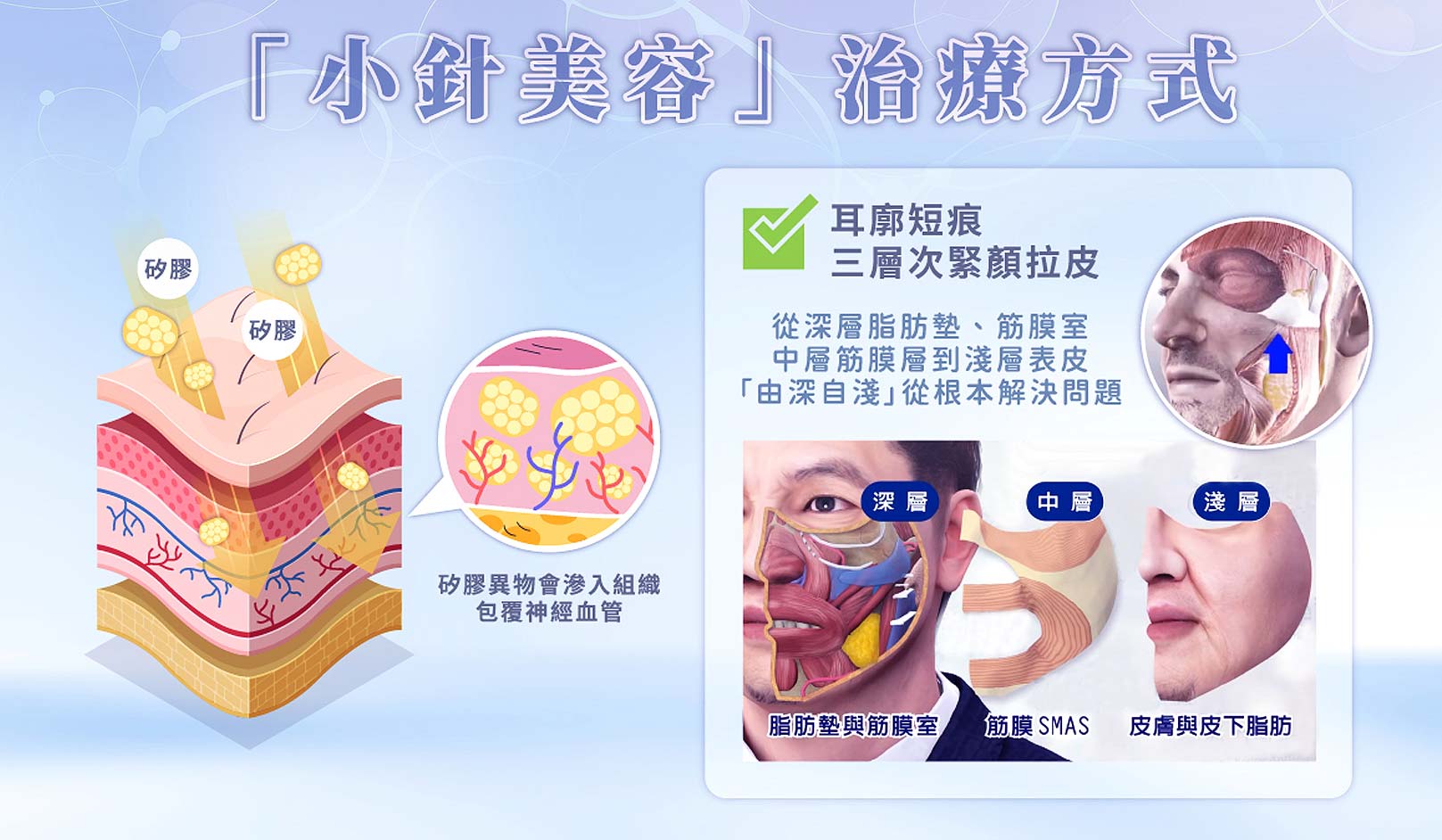 韓后醫美,小針美容治療方式：耳廓短痕，三層次緊顏拉皮，從深層脂肪墊、筋膜室，中層筋膜層到淺層表皮「由深自淺」從根本解決問題。