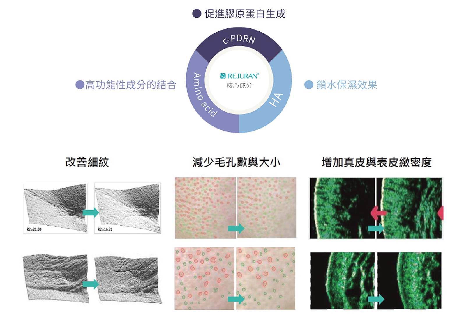 韓后醫美,麗珠蘭,麗珠蘭PDRN修復水光,促進膠原蛋白生成,高功能性成分的結合,鎖水保濕效果,改善細紋,減少毛孔數與大小,增加真皮與表皮緻密度。
