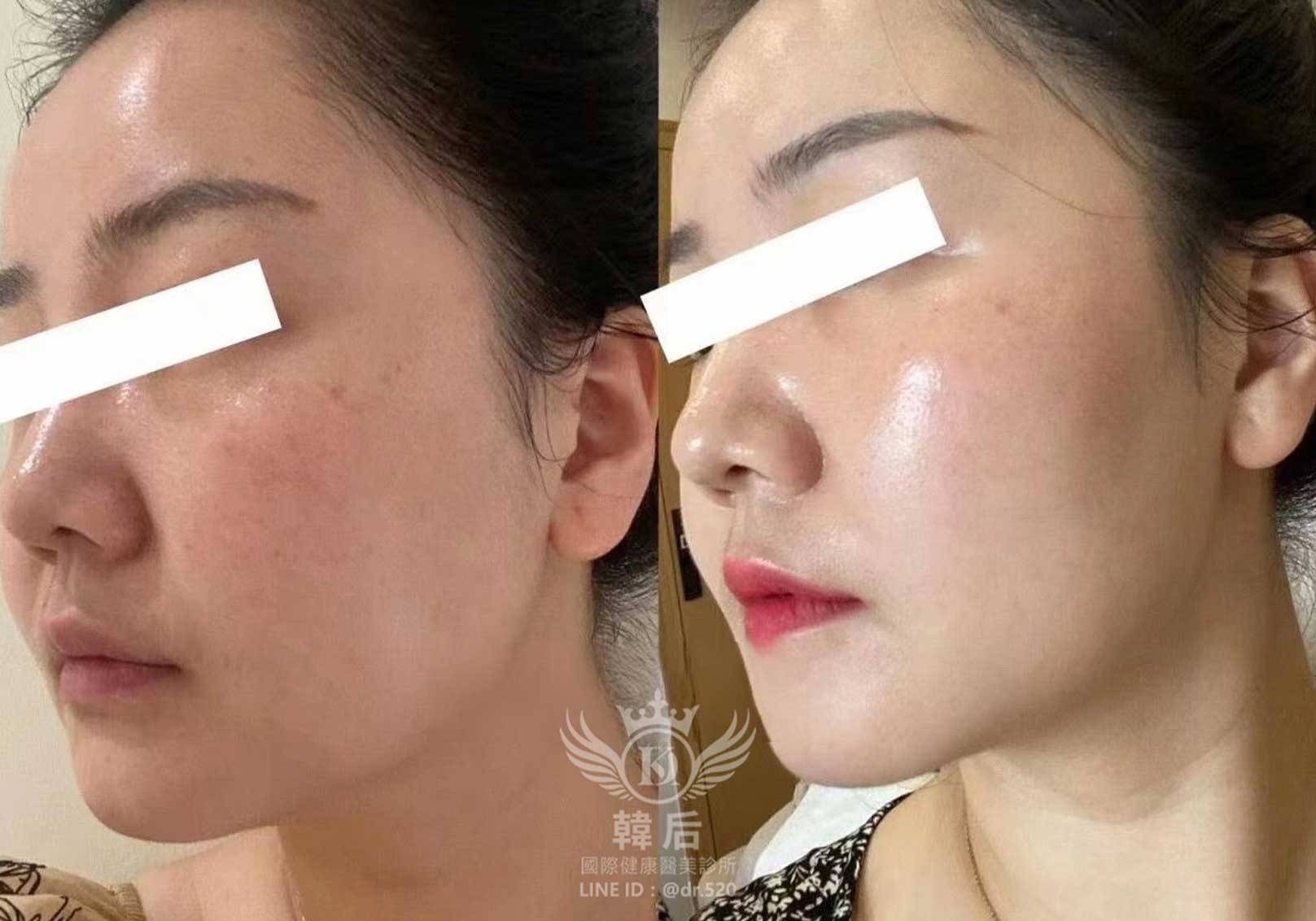 韓后醫美,麗珠蘭,麗珠蘭Rejuran,水光,素人真實案例
