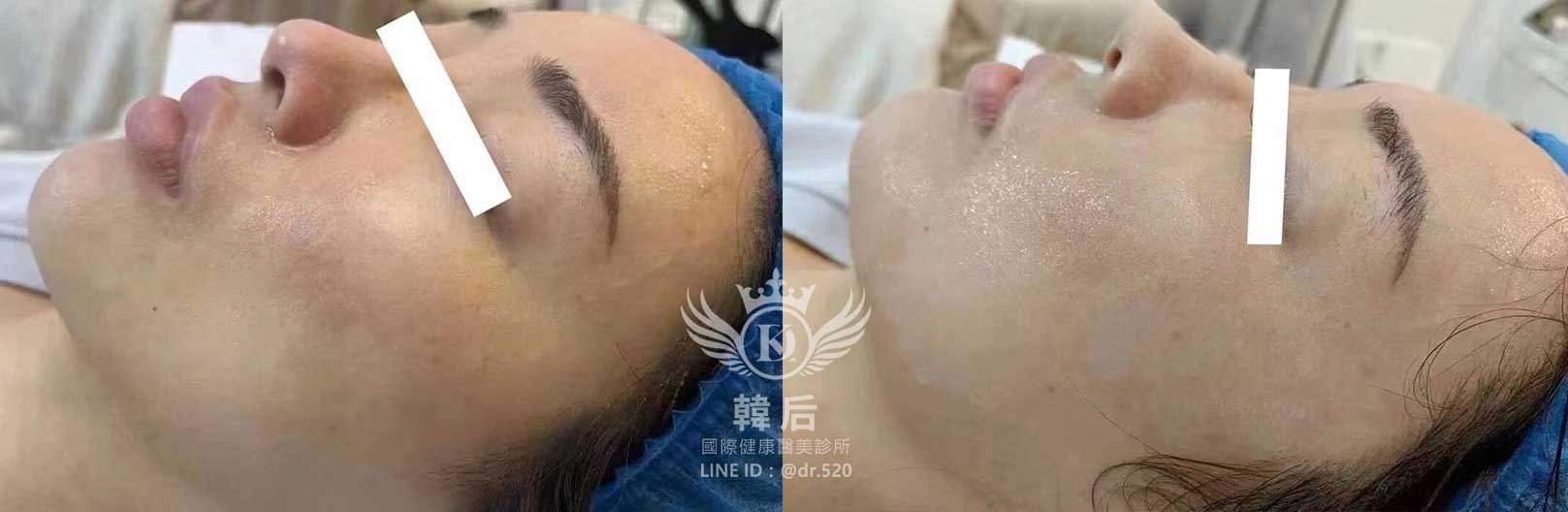 韓后醫美,麗珠蘭,麗珠蘭Rejuran,水光,素人真實案例