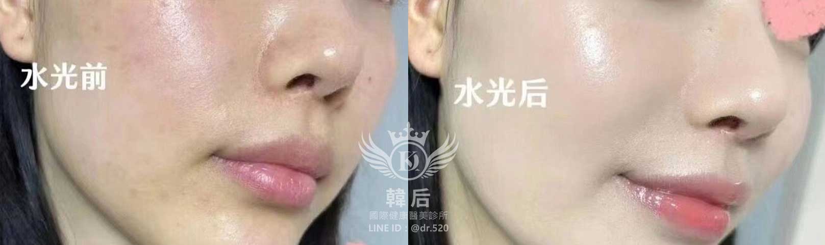 韓后醫美,麗珠蘭,麗珠蘭Rejuran,水光,素人真實案例