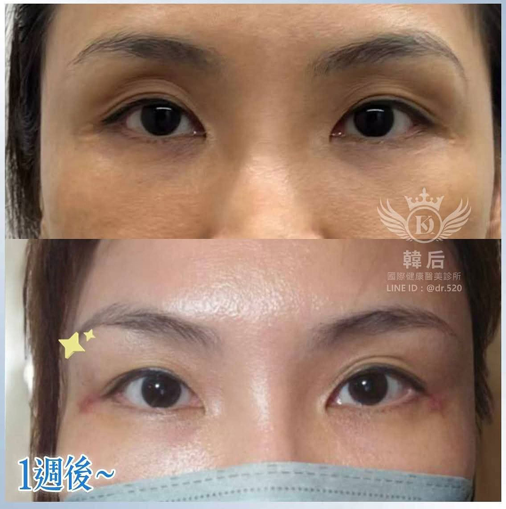 韓后醫美 免手術除眼窩凹陷 真實見證