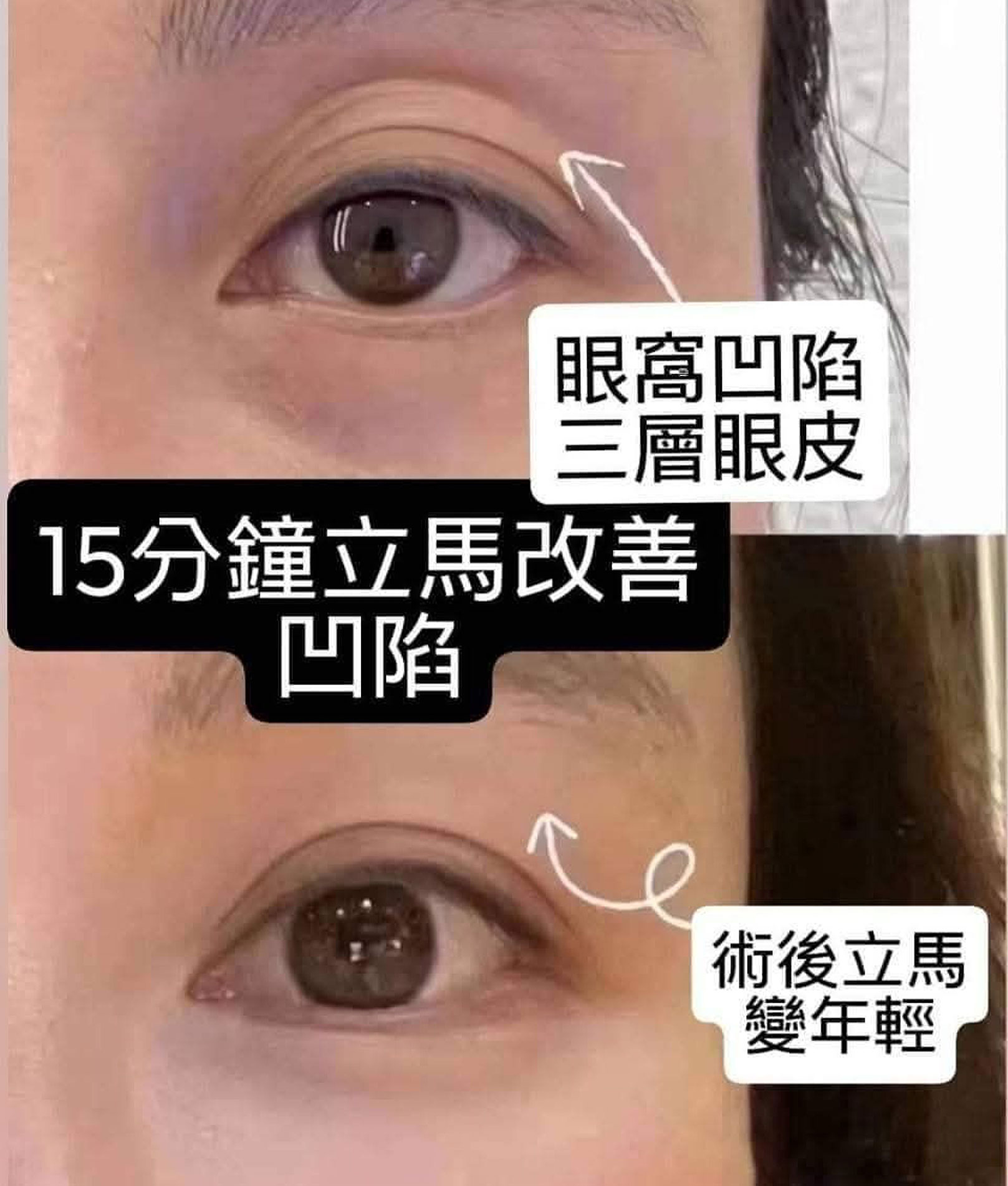 韓后醫美 免手術除眼窩凹陷 真實見證