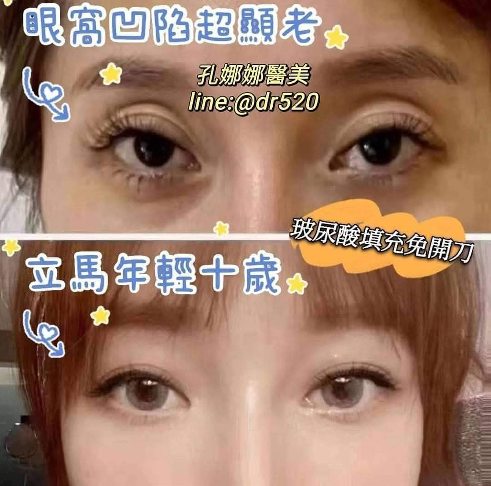韓后醫美 免手術除眼窩凹陷 真實見證