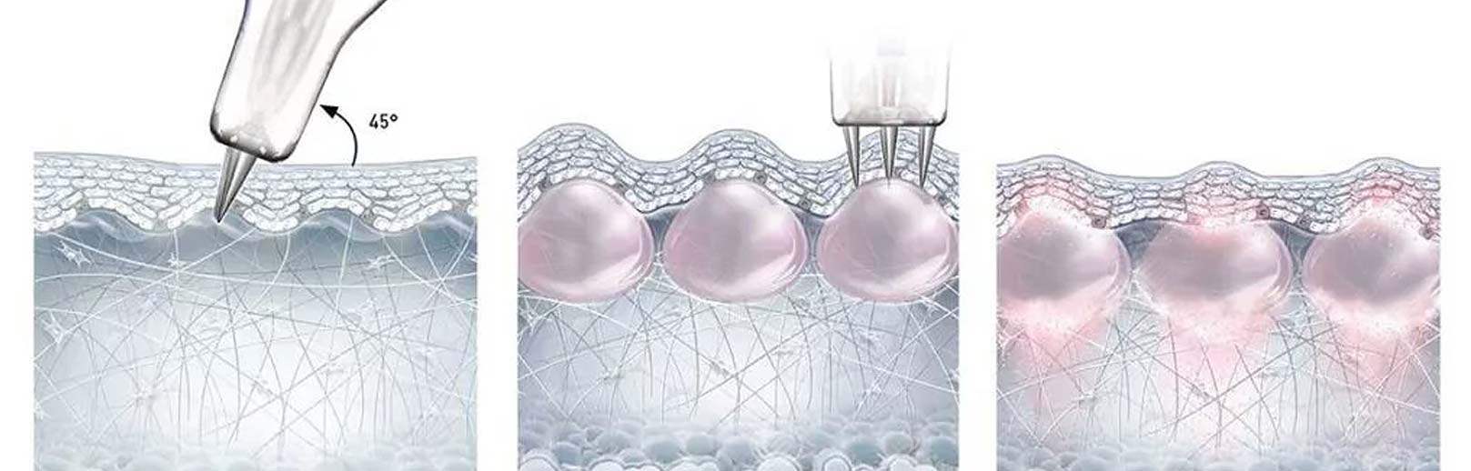 香奈兒針NCTF適合：機打/微針導入,手打/注射