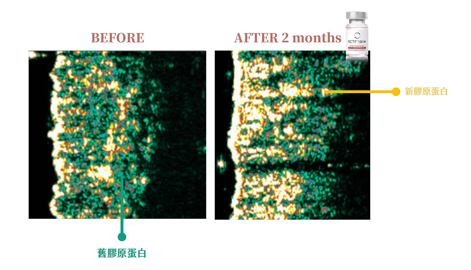 香奈兒針NCTF適合：機打/微針導入,手打/注射