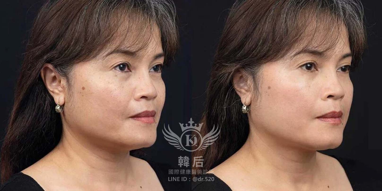 香奈兒針NCTF 135HA,小粉瓶,素人真實案例,韓后醫美