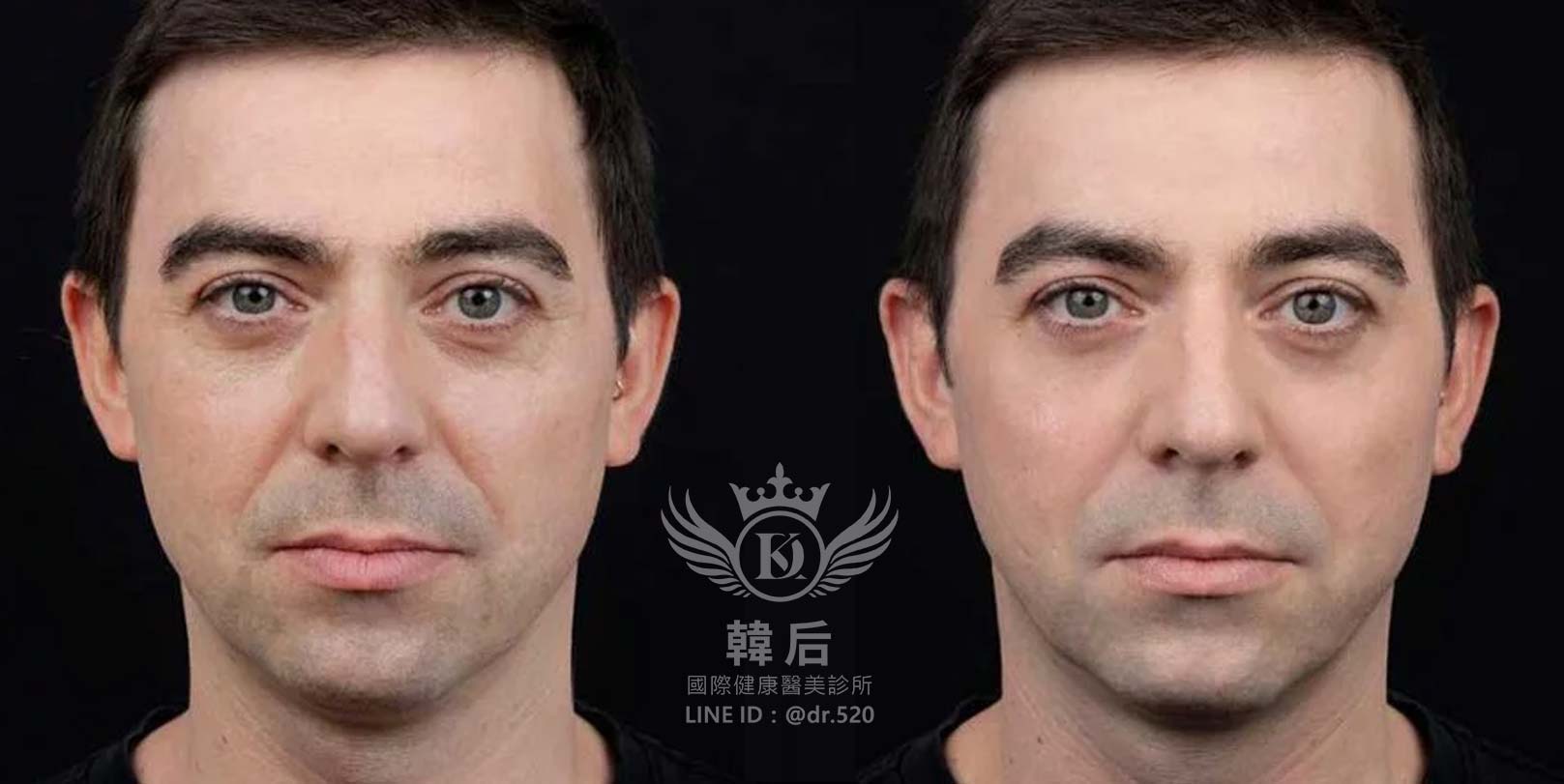 香奈兒針NCTF 135HA,小粉瓶,素人真實案例,韓后醫美