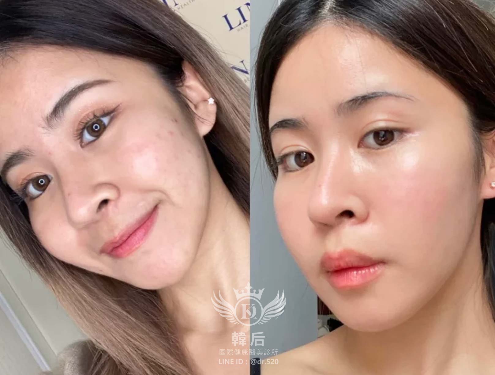 香奈兒針NCTF 135HA,小粉瓶,素人真實案例,韓后醫美