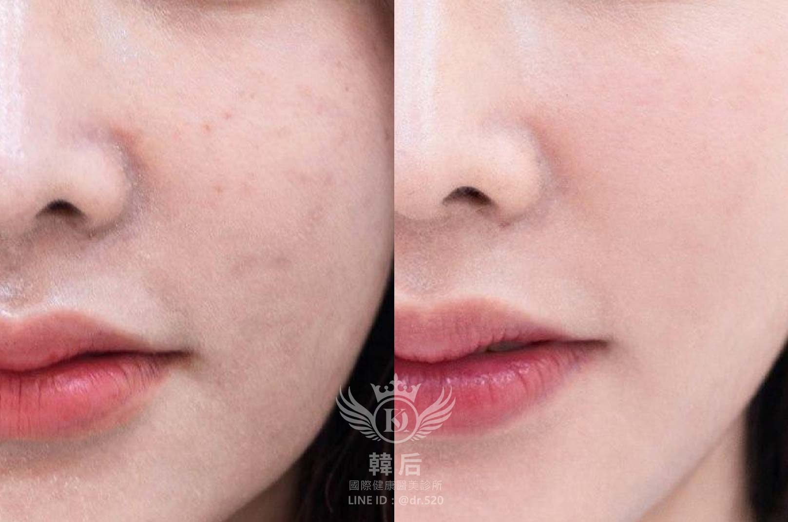 香奈兒針NCTF 135HA,小粉瓶,素人真實案例,韓后醫美