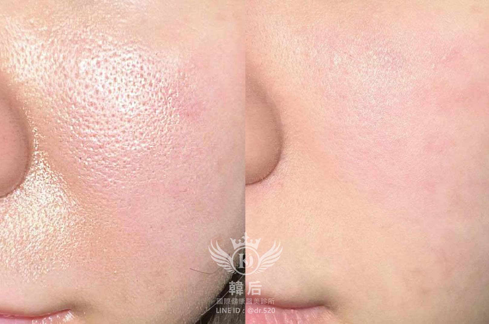 香奈兒針NCTF 135HA,小粉瓶,素人真實案例,韓后醫美