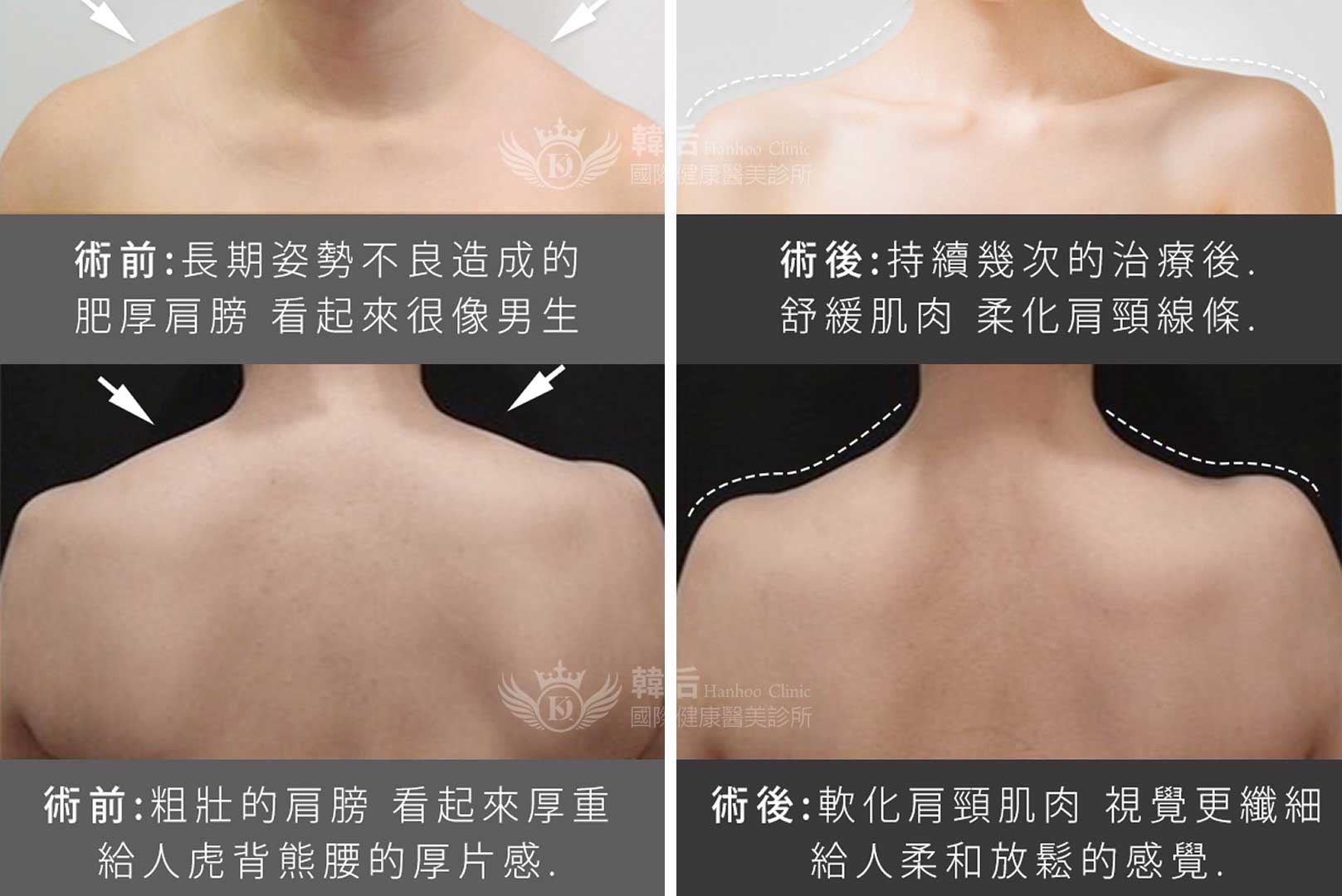 韓后醫美 肉毒 天鵝頸 美人肩 素人真實案例