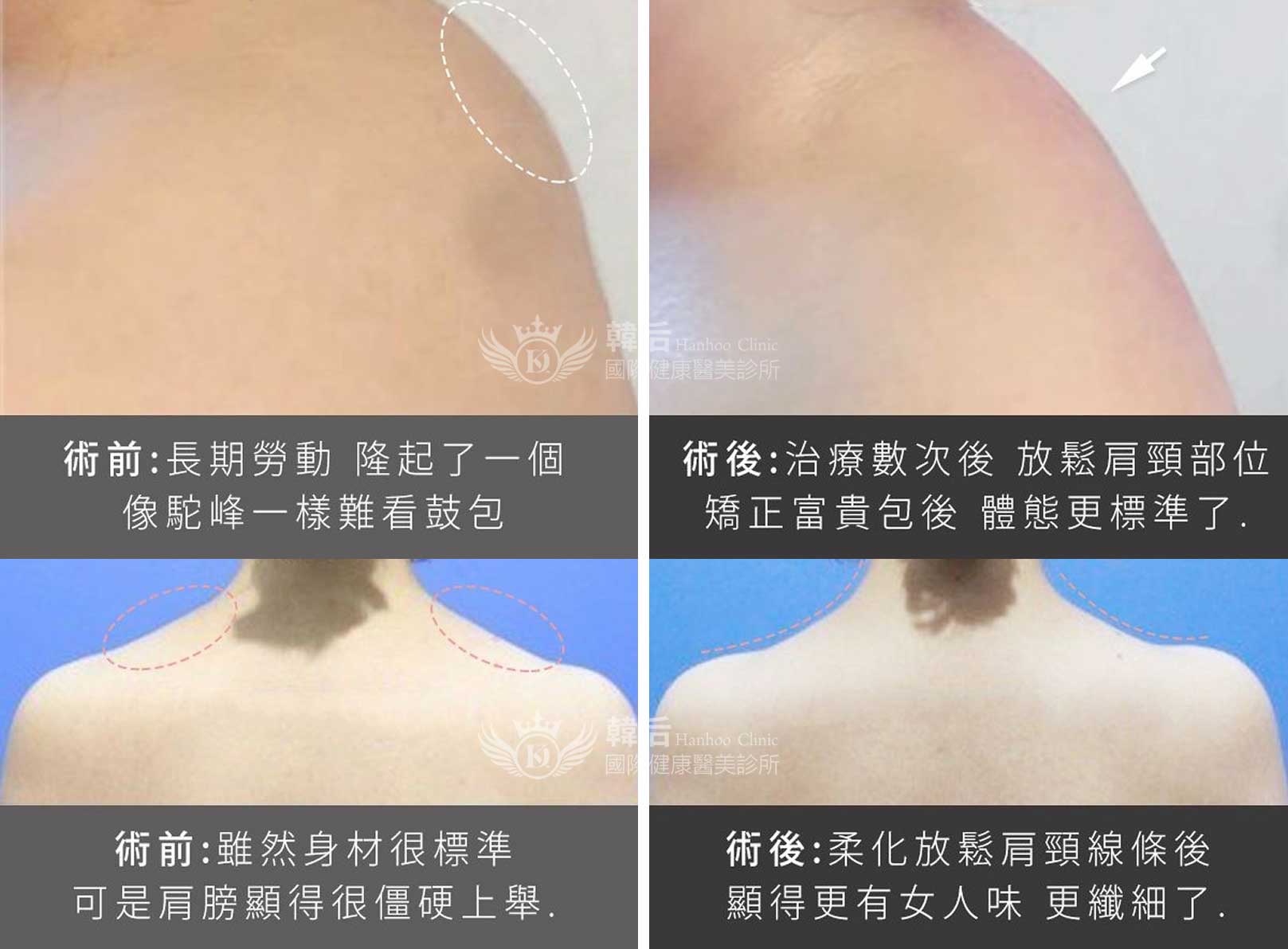 韓后醫美 肉毒 天鵝頸 美人肩 素人真實案例