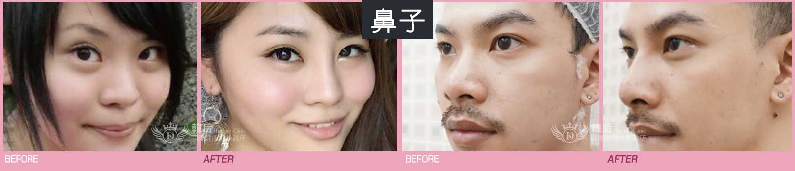 韓后醫美 玻尿酸作用於鼻子 素人真實案例