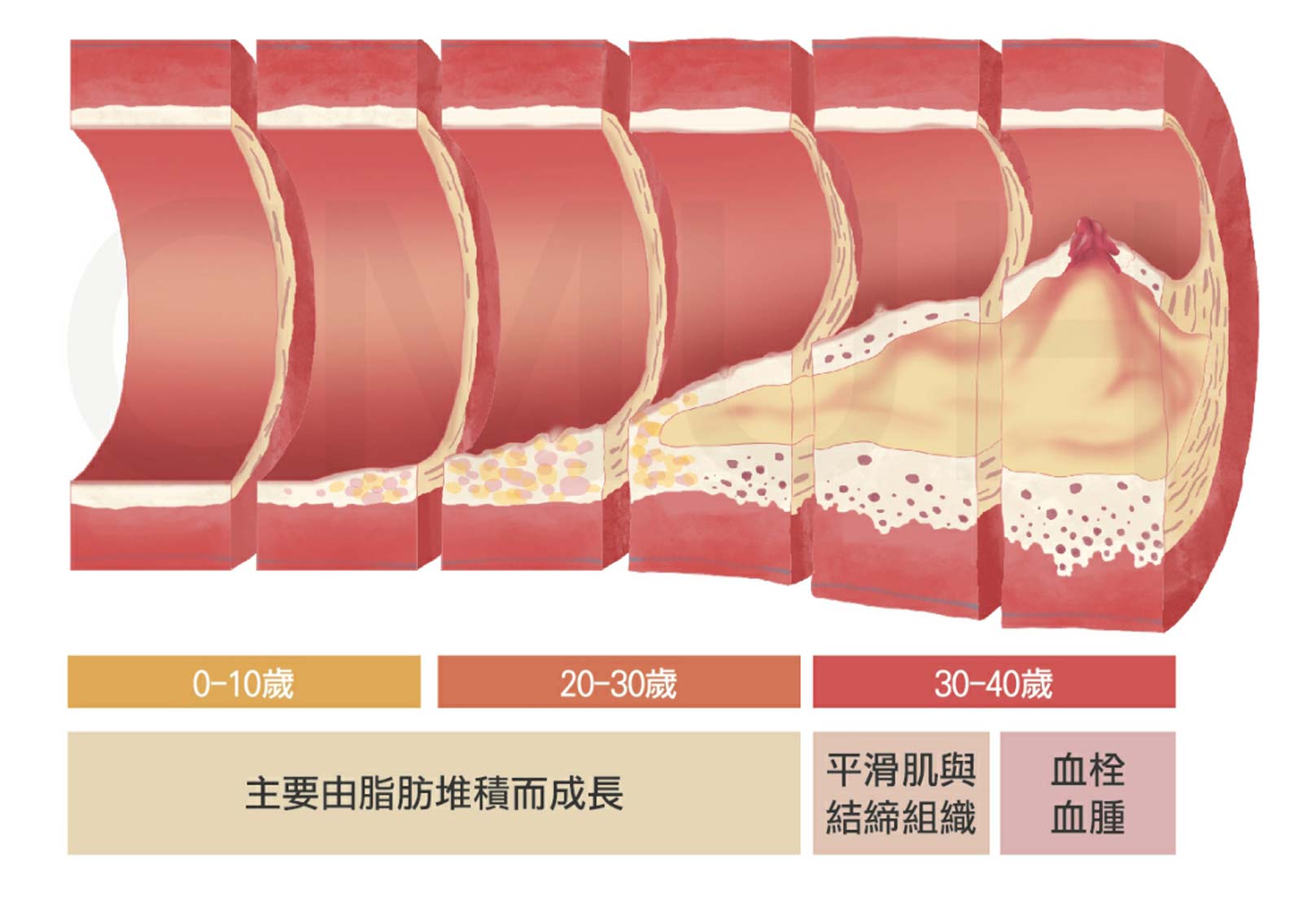 韓后醫美 脂肪長期囤積在血管內壁上,久而久之即造成動脈硬化,可能會發生血管阻塞,引發心臟疾病如心絞痛或心肌梗塞,或是腦血管病變如腦梗塞或是腦出血。