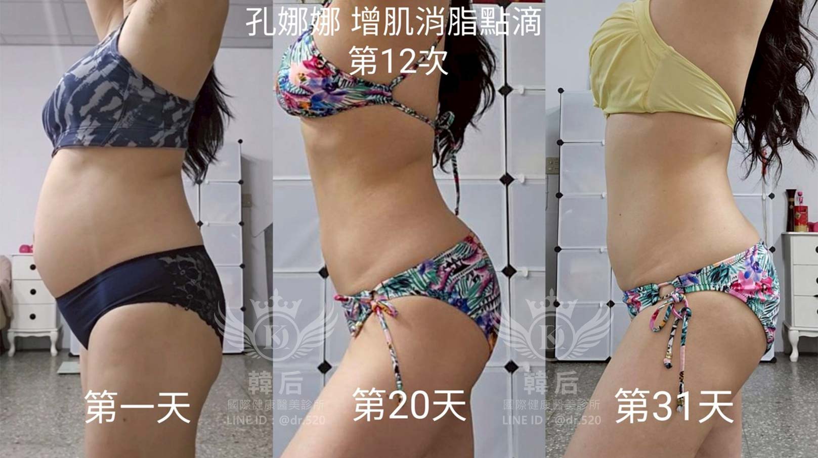 韓后醫美,增肌消脂點滴,燃脂點滴,代謝點滴,韓后執行長,孔娜娜,韓國台灣醫美CEO,改造前後,真實案例