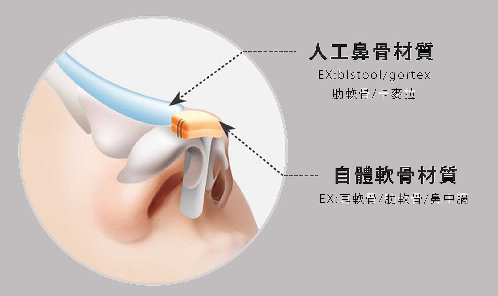 韓后醫美 韓式多段式 /複合式隆鼻