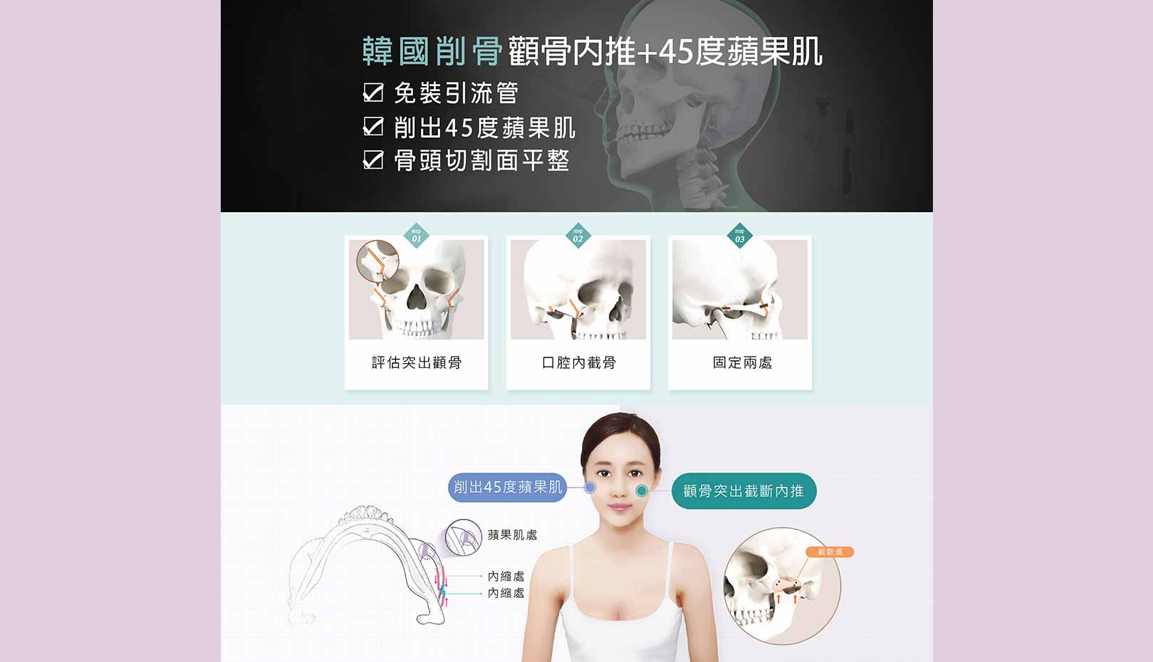 韓國削骨顴骨內推+45度蘋果肌，免裝引流管、削出45度蘋果肌、骨頭切割面平整