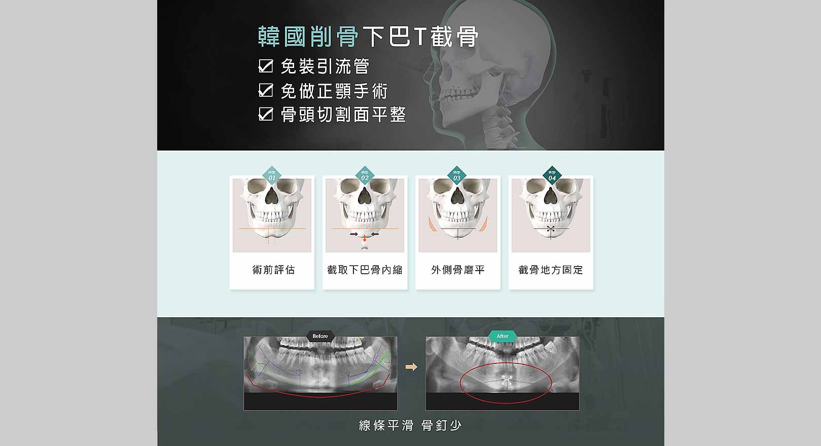 下巴T截骨