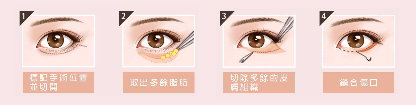 韓后醫美 眼袋外開手術：標記手術位置並切開 → 取出多餘脂肪 → 切除多餘的皮膚組織 → 縫合傷口