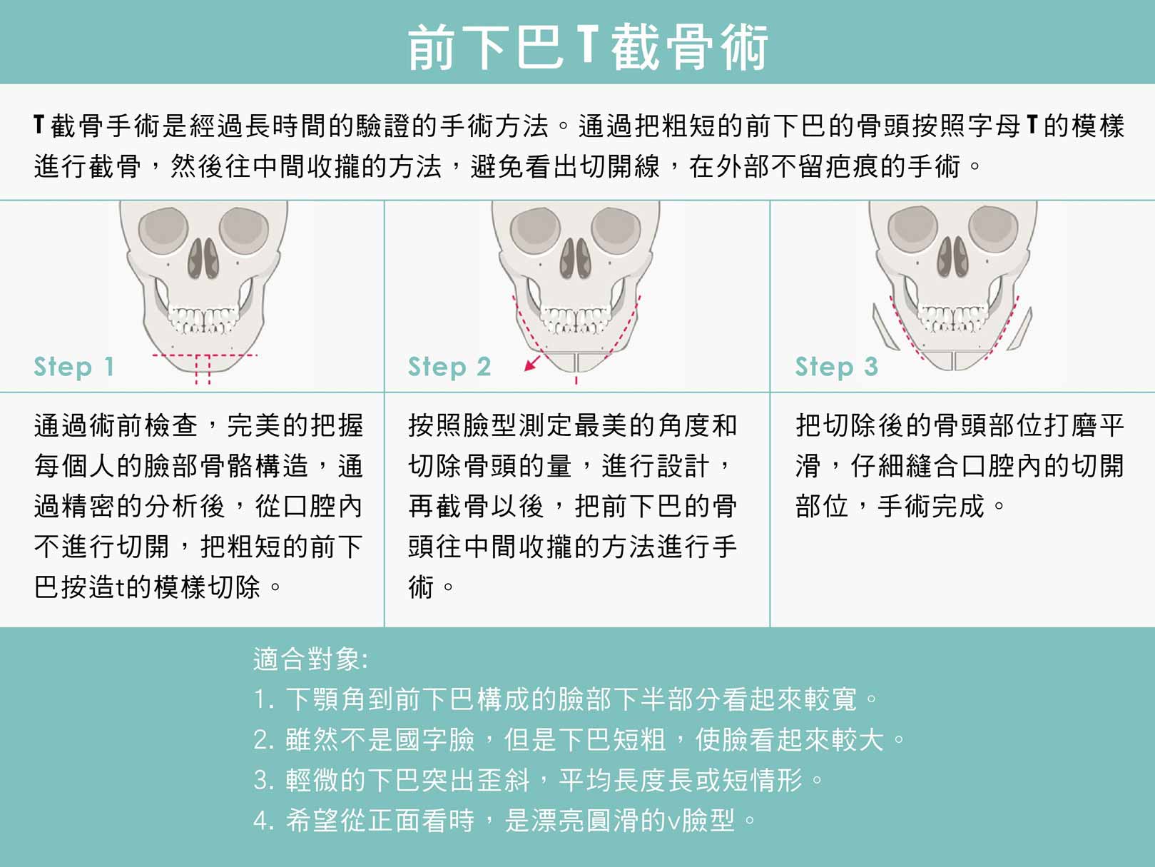 下巴T截骨