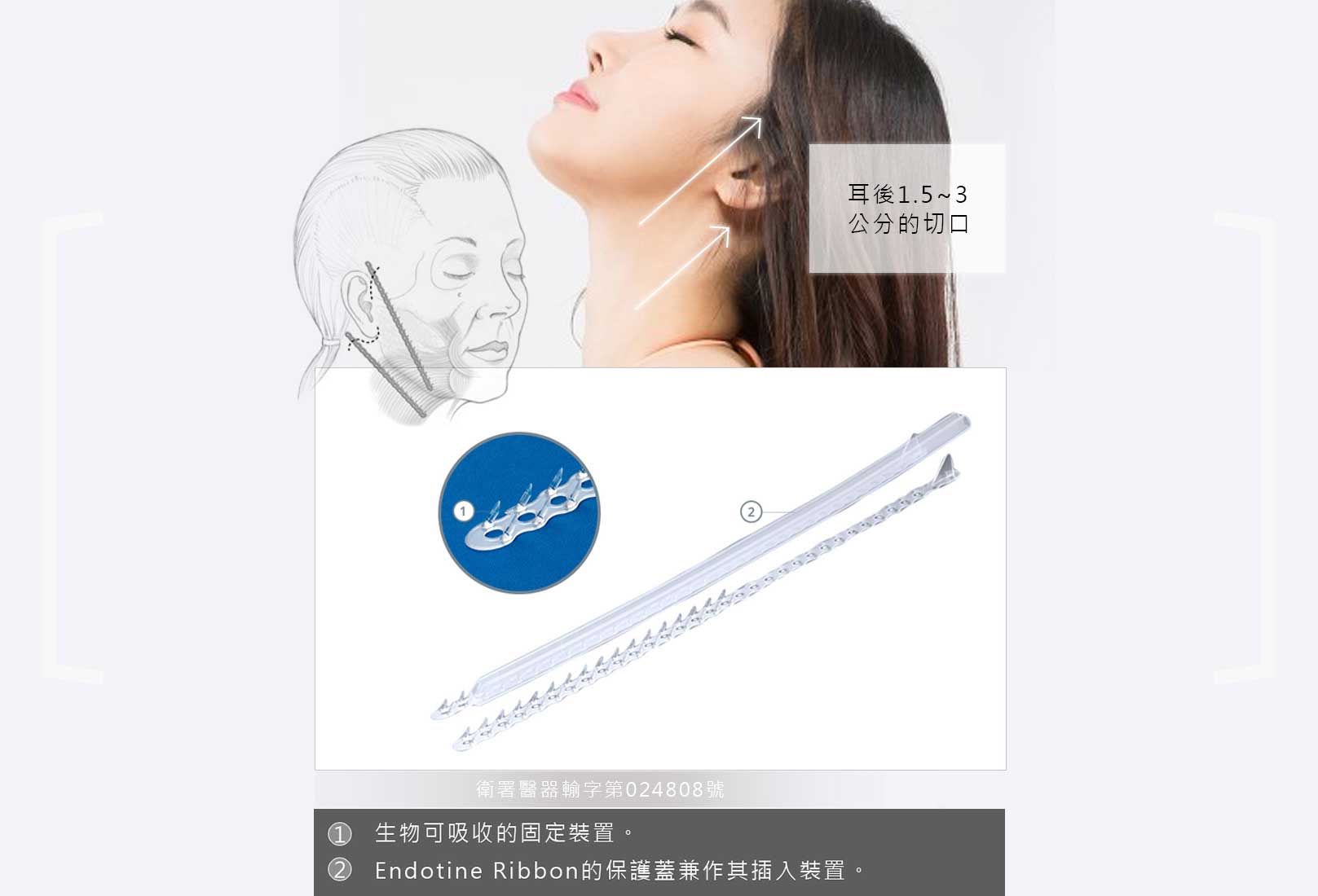 韓后醫美 內視鏡下臉（頸部）拉提：耳後1.5~3cm的切口。
