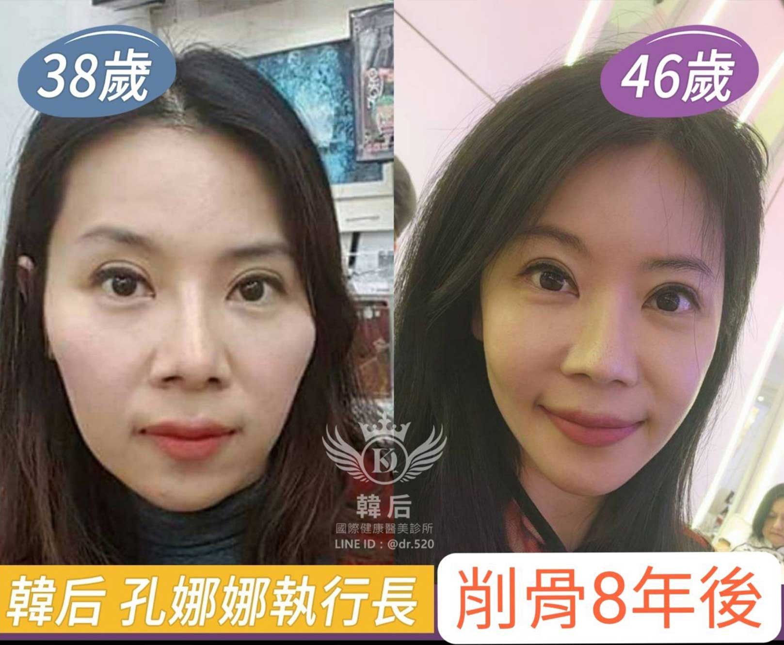 韓后削骨案例 孔娜娜執行長