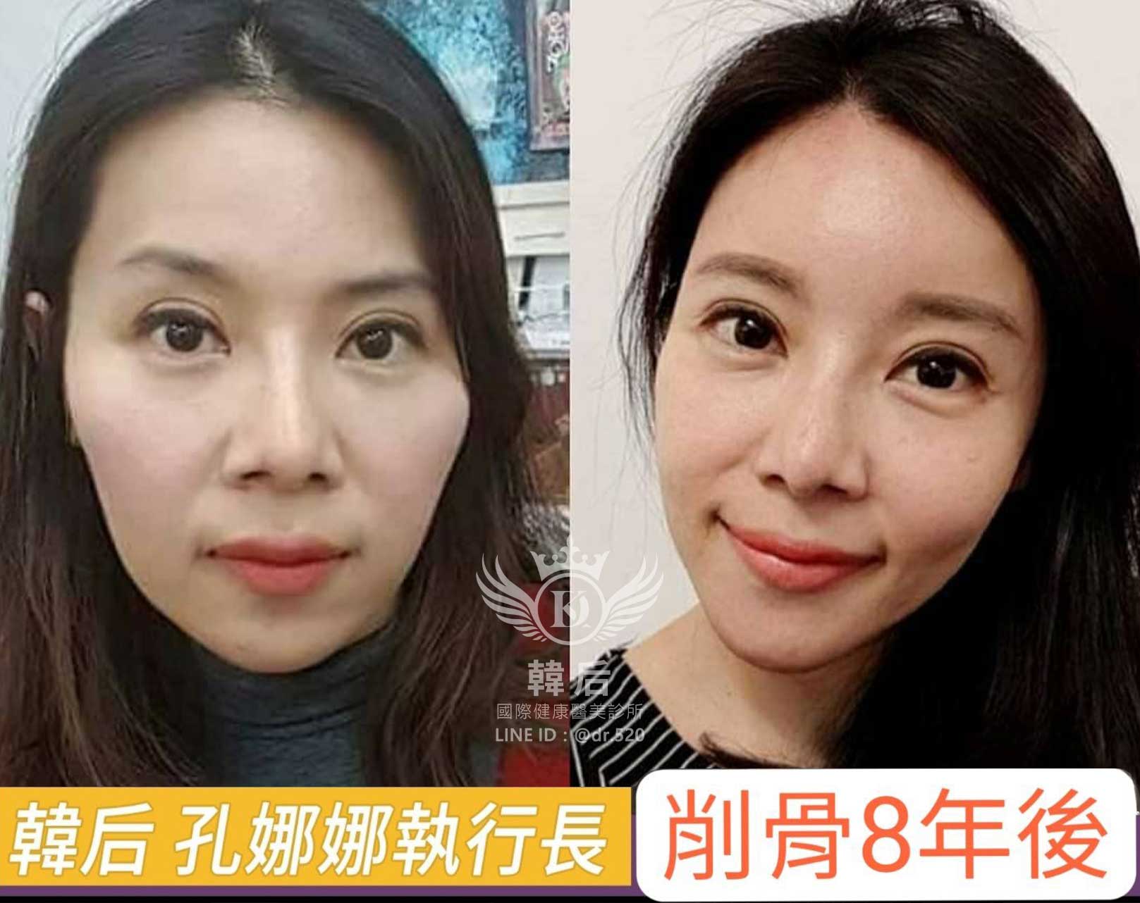 韓后削骨案例 孔娜娜執行長