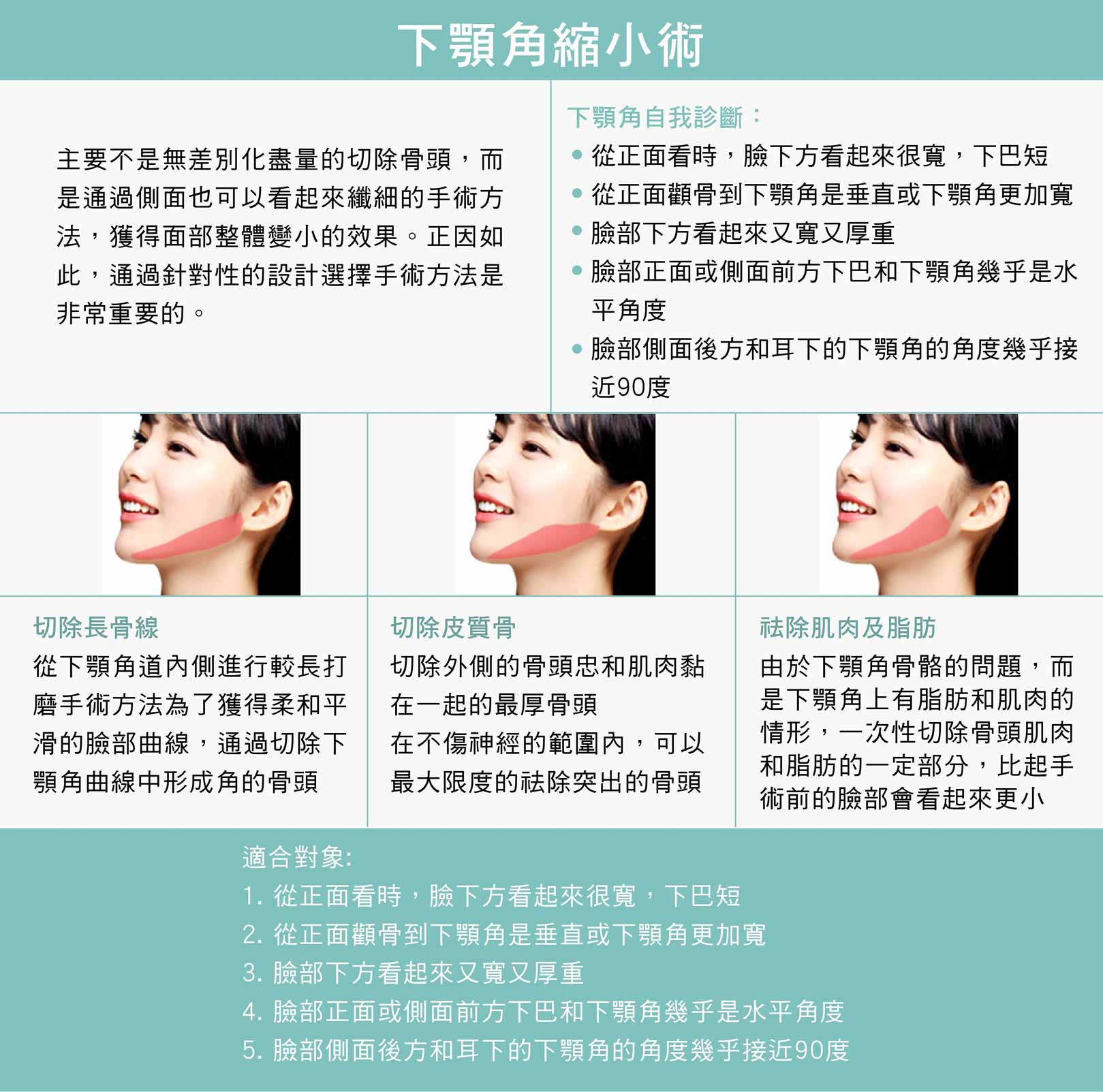 下顎角縮小術