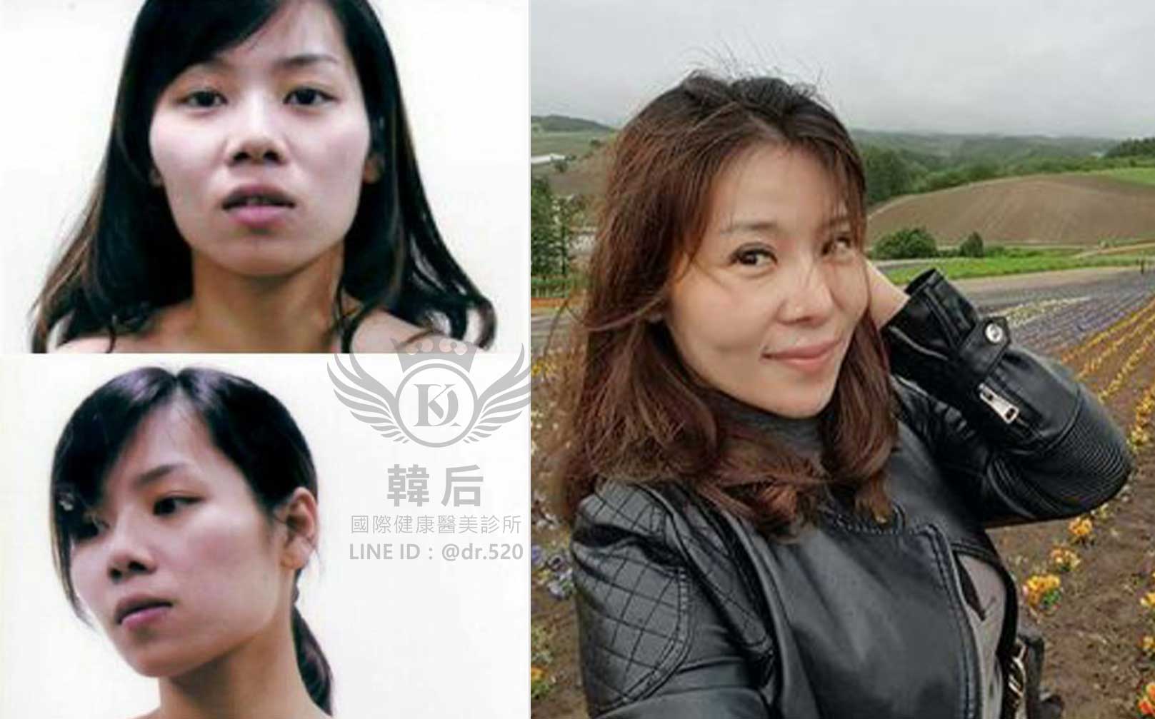 削骨,韓國削骨,上海削骨,磨骨,削骨手術,削骨十年,臉型雕塑,醫美執行長,醫美日常