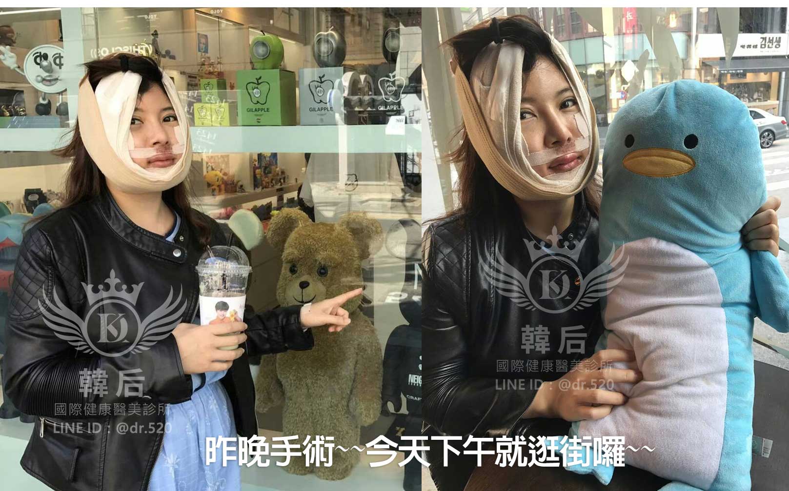 削骨,韓國削骨,上海削骨,磨骨,削骨手術,削骨十年,臉型雕塑,醫美執行長,醫美日常