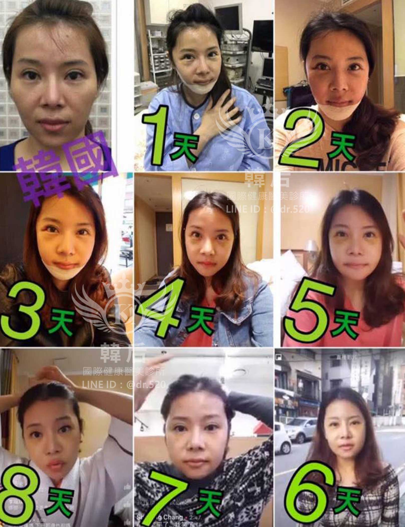削骨,韓國削骨,上海削骨,磨骨,削骨手術,削骨十年,臉型雕塑,醫美執行長,醫美日常