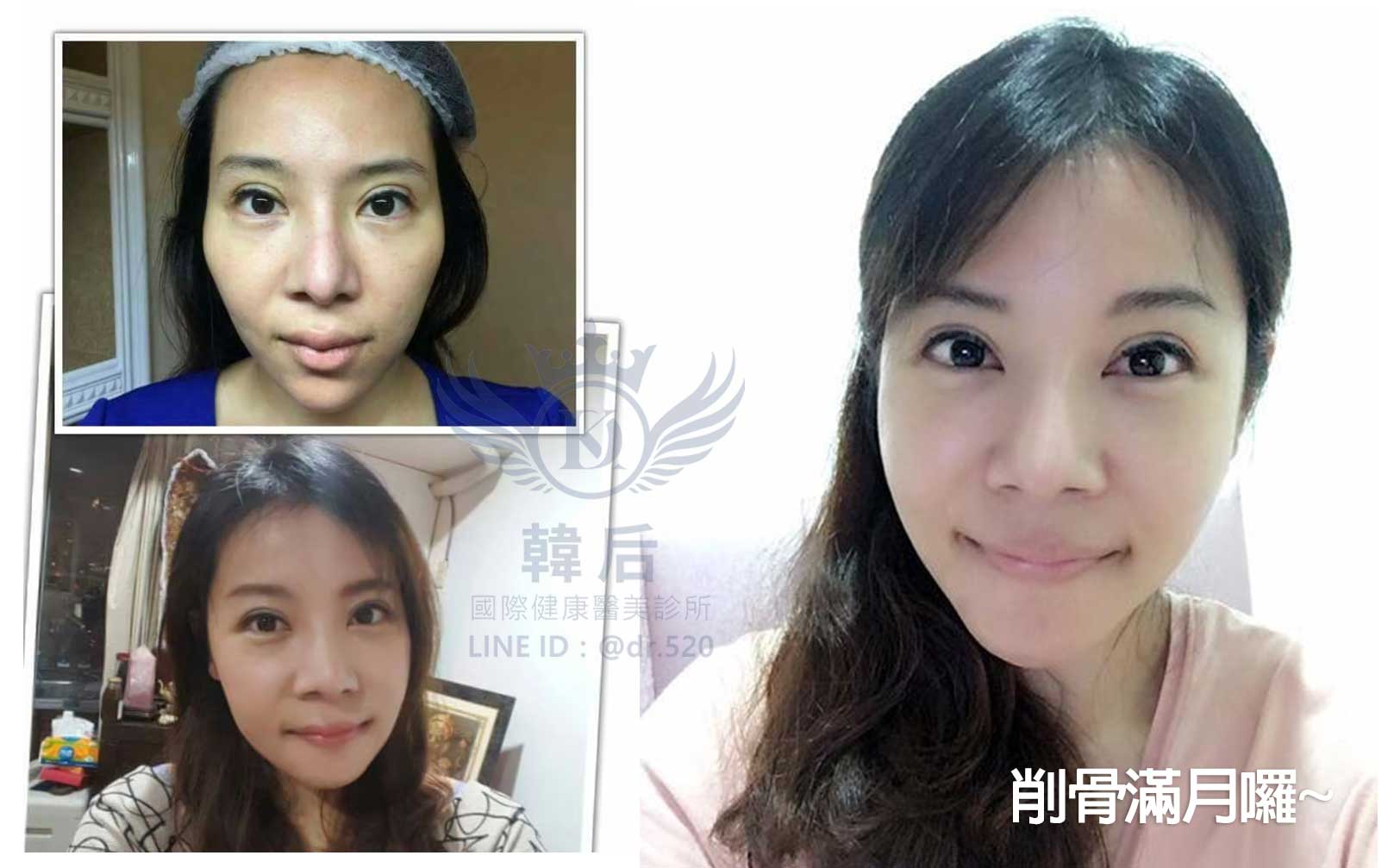 削骨,韓國削骨,上海削骨,磨骨,削骨手術,削骨十年,臉型雕塑,醫美執行長,醫美日常
