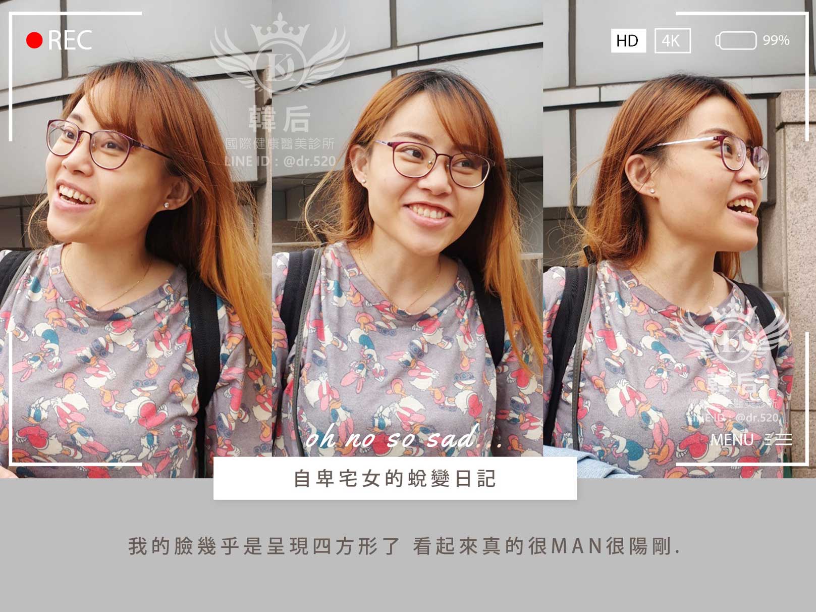 削骨,韓國削骨,上海削骨,磨骨,削骨手術,削骨十年,臉型雕塑,瘋狂小妞騏騏變美日記,騏騏,醫美,變美日記