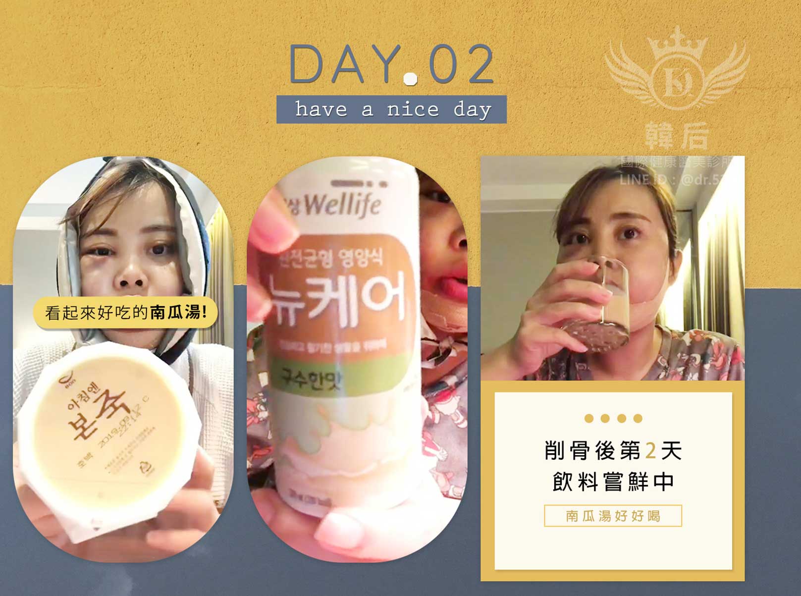 削骨後第二天，流質飲品南瓜湯好好喝喔~韓國削骨權威,削骨手術,金一秀院長,韓國削骨,磨骨,臉型雕塑,瘋狂小妞騏騏變美日記,騏騏,醫美,變美日記