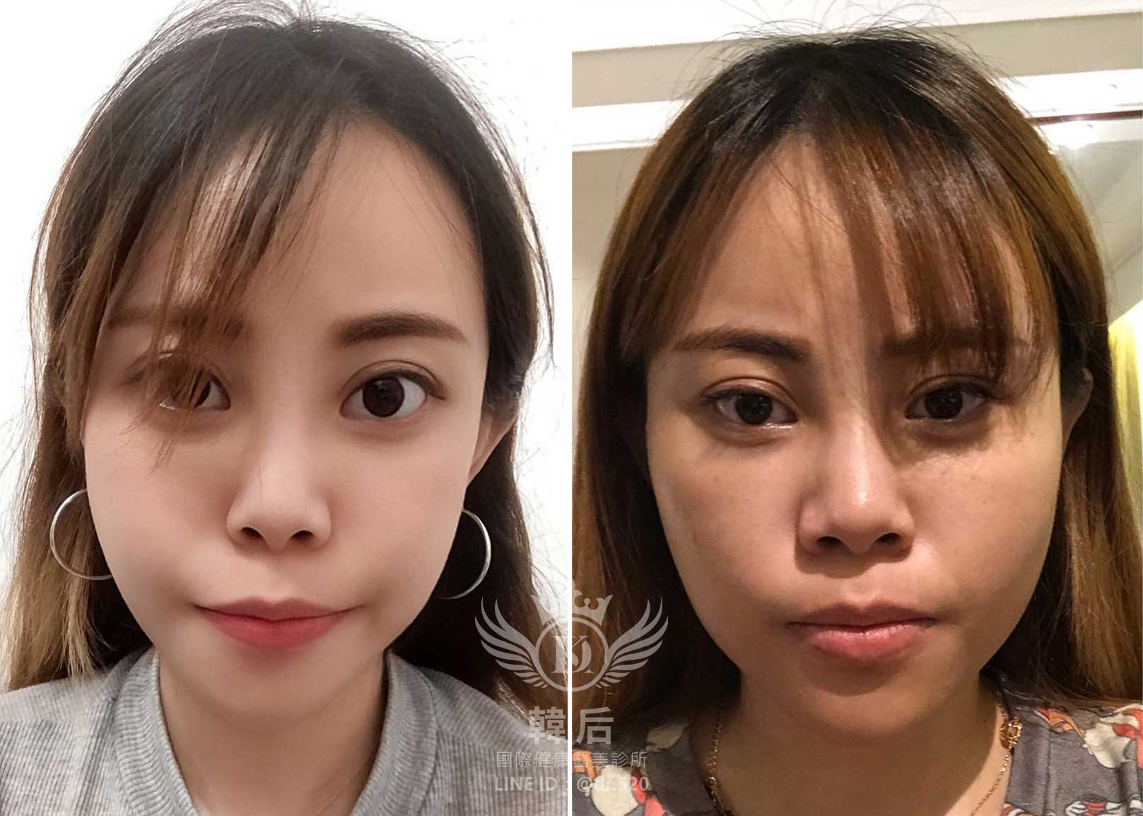 削骨後滿三個月,韓國削骨權威,削骨手術,金一秀院長,韓國削骨,磨骨,臉型雕塑,瘋狂小妞騏騏變美日記,騏騏,醫美,變美日記