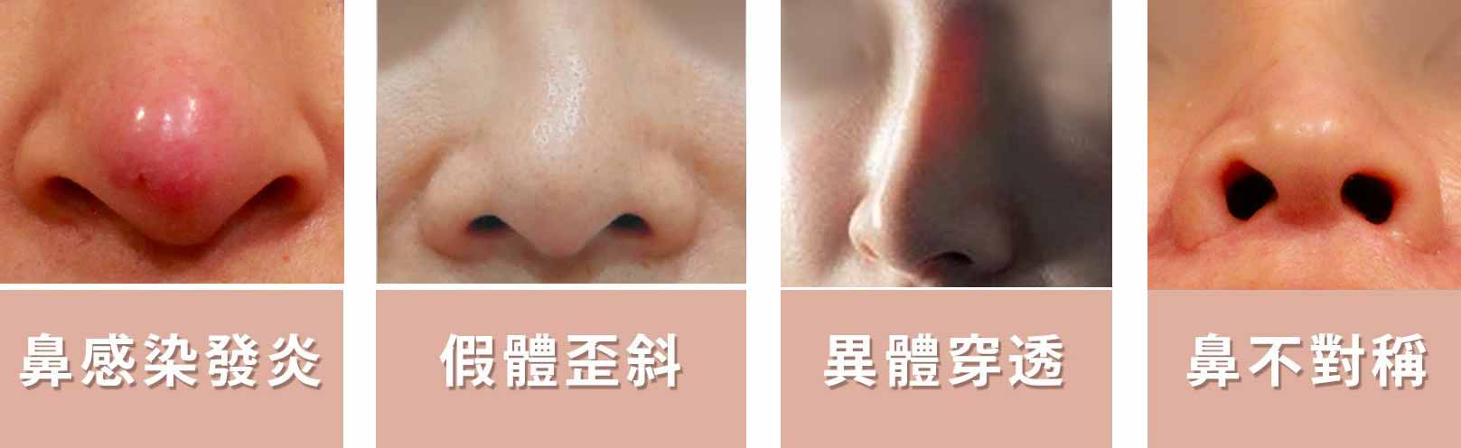 鼻感染發炎、假體歪斜、異體穿透、鼻不對稱