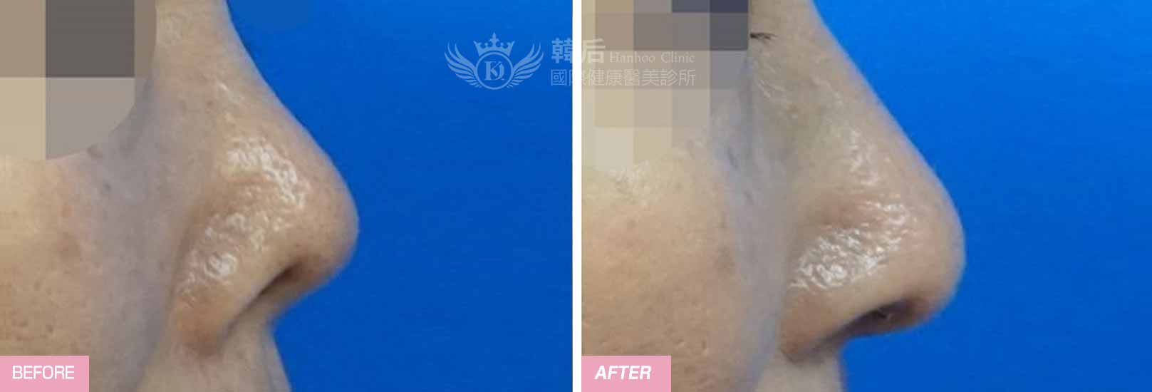 韓后醫美 素人真實案例