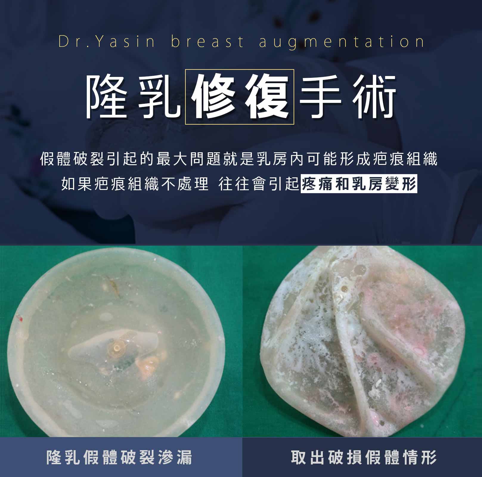 隆乳修復手術-假體破裂引起的最大問題就是乳房內可能形成疤痕組織，如果疤痕組織不處理，往往會引起疼痛和乳房變形。隆乳假體破裂滲漏、取出破損假體情形。