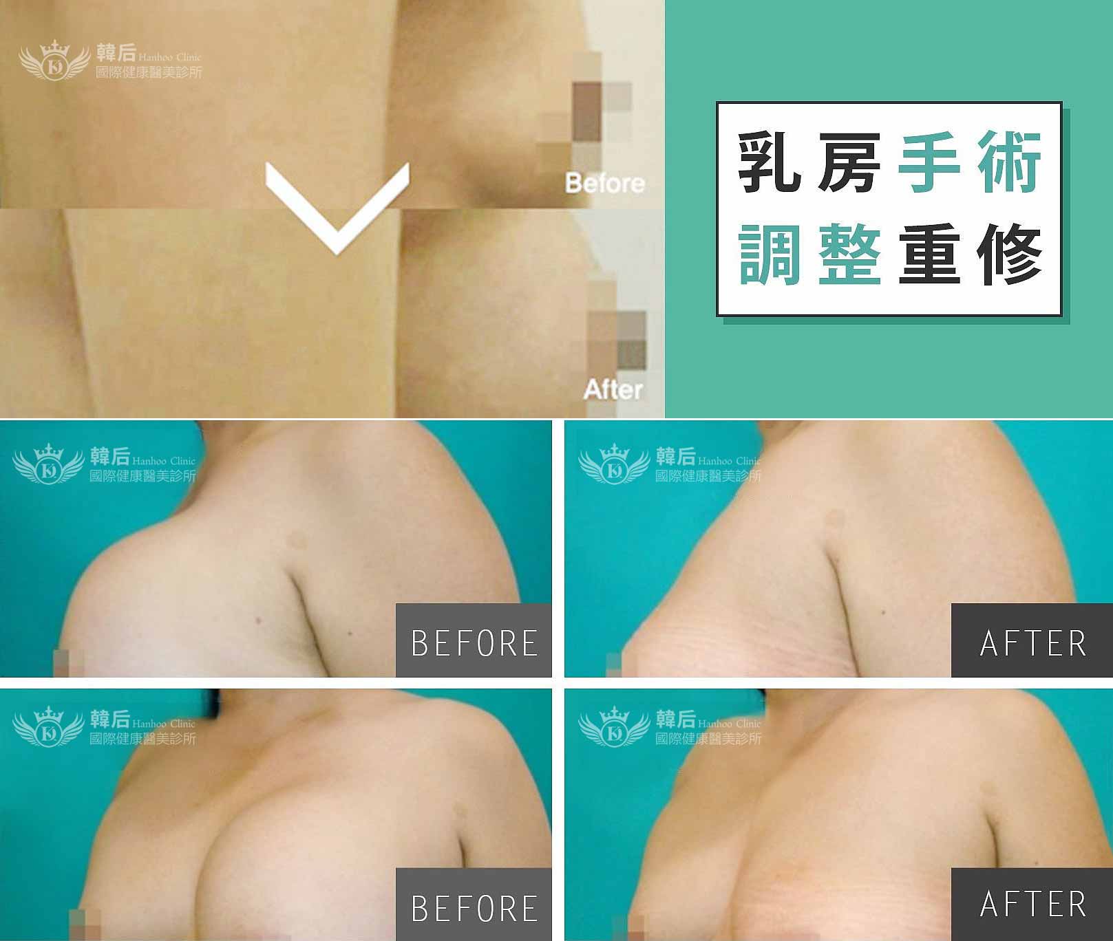 韓后醫美 隆乳 素人真實案例